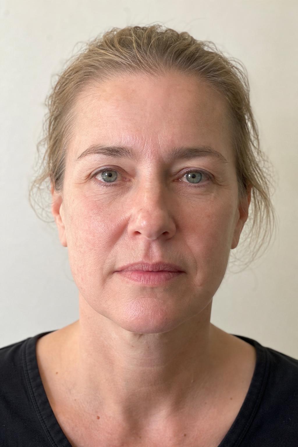 Before Triple Lift Facial treatment