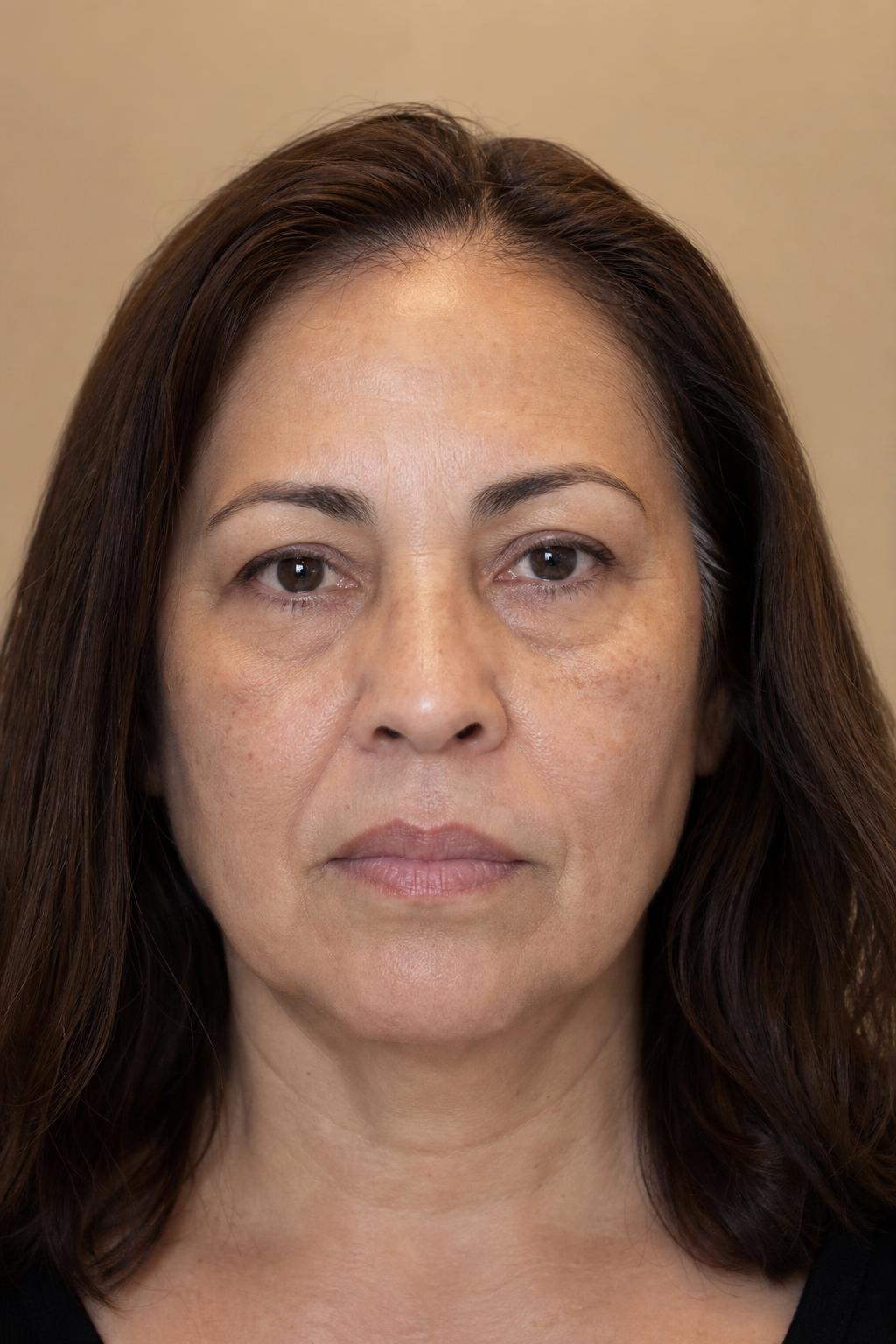 After Triple Lift Facial treatment