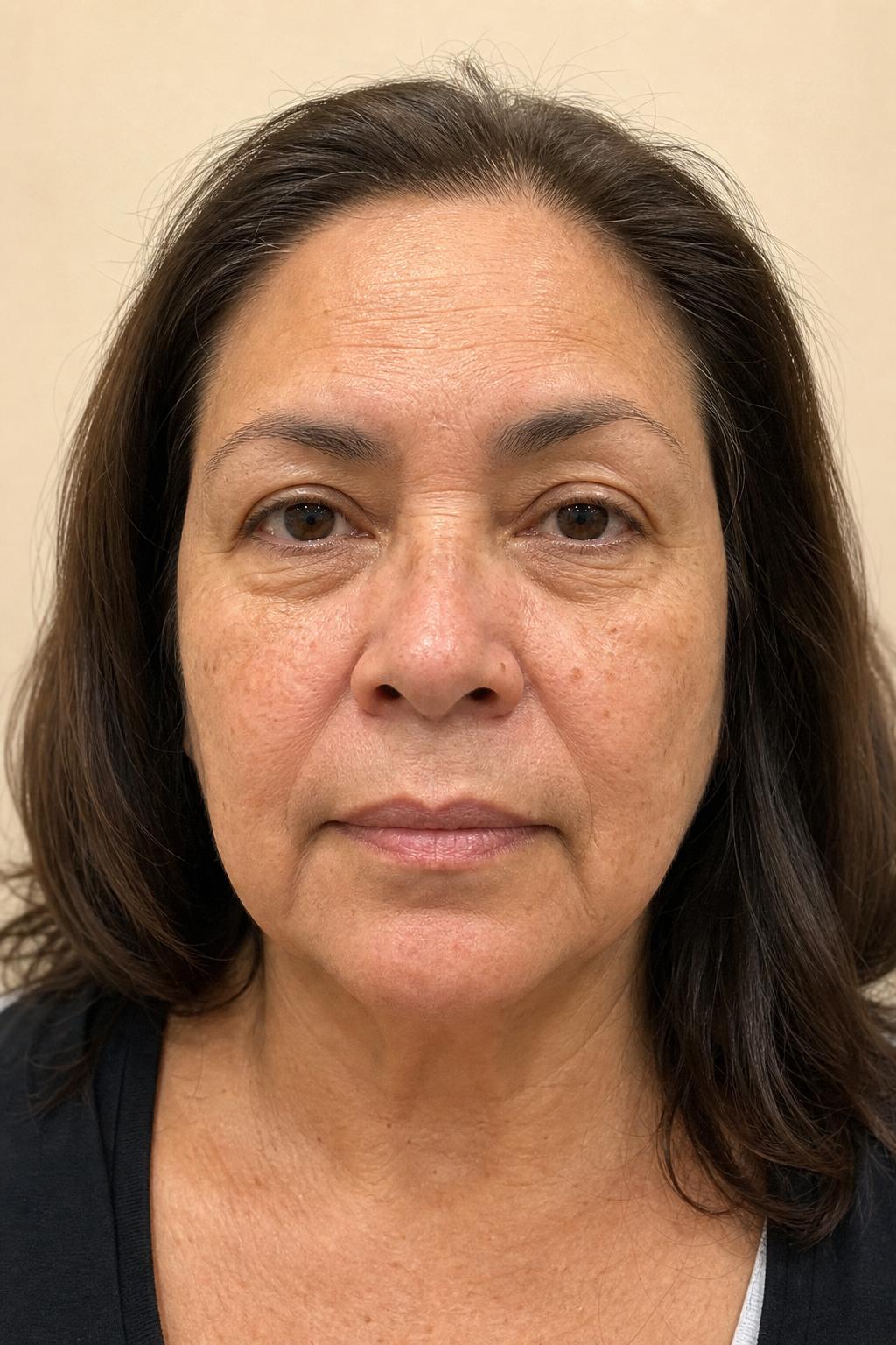 Before Triple Lift Facial treatment